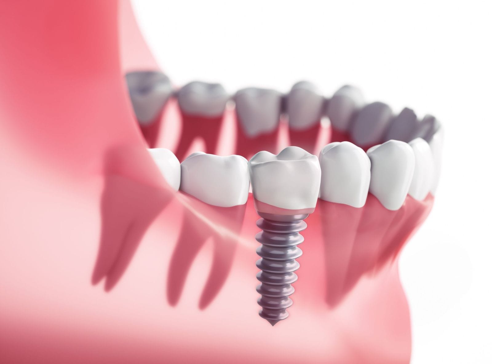 Implant dentaire : À quoi il sert l’implant dentaire ?
