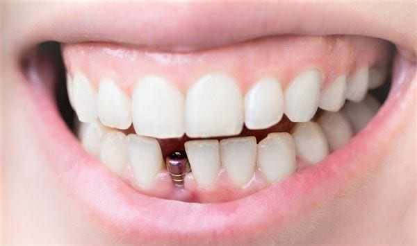 Implant dentaire Lyon : est-ce l’intervention dont vous avez besoin ?