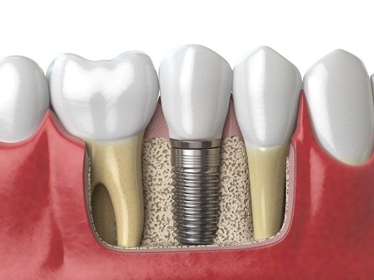 Implant dentaire Lyon : quelles sont les contres-indications qui peuvent mener l'implant à l'échec ?